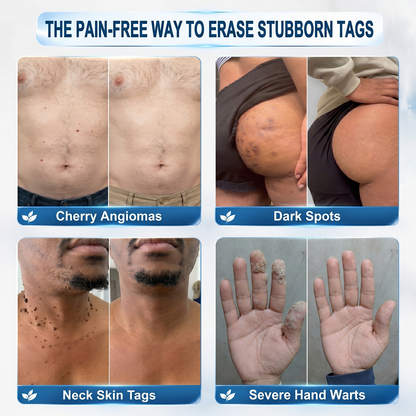 Official Store🚀𝐏i𝐜𝐝o® 7-𝐷𝑎𝑦 𝗧𝐚𝐠 & 𝗦𝗽𝐨𝐭 𝐄𝐫𝒂𝒔𝒆𝒓(Zero Pain, Zero 𝐒𝐜𝐚𝒓𝒔 Rollerball)