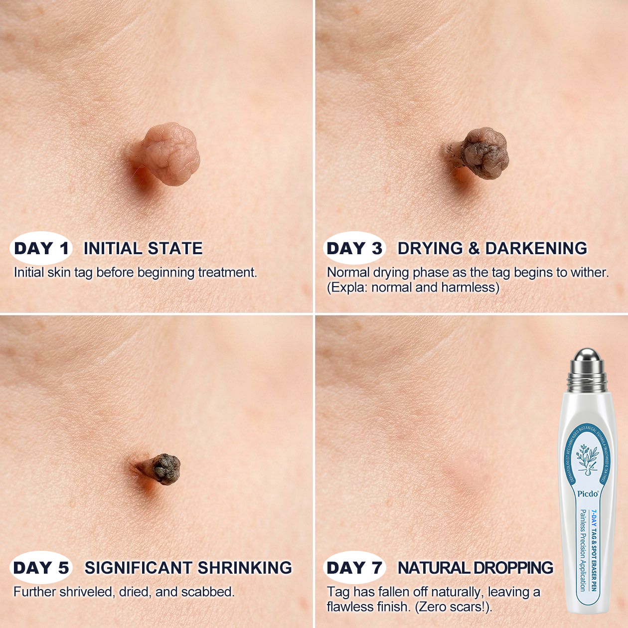 Official Store🚀𝐏i𝐜𝐝o® 7-𝐷𝑎𝑦 𝗧𝐚𝐠 & 𝗦𝗽𝐨𝐭 𝐄𝐫𝒂𝒔𝒆𝒓(Zero Pain, Zero 𝐒𝐜𝐚𝒓𝒔 Rollerball)