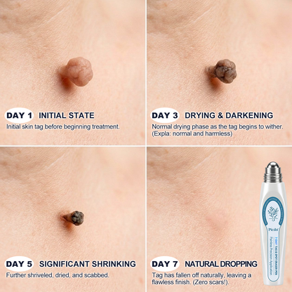 Official Store🚀𝐏i𝐜𝐝o® 7-𝐷𝑎𝑦 𝗧𝐚𝐠 & 𝗦𝗽𝐨𝐭 𝐄𝐫𝒂𝒔𝒆𝒓(Zero Pain, Zero 𝐒𝐜𝐚𝒓𝒔 Rollerball)